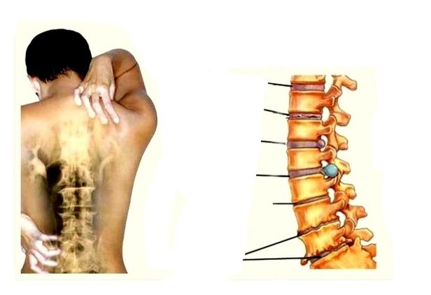 Fáze vývoje osteochondrosy