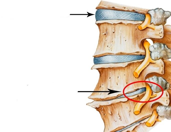 poškozený disk a porušené nervy s cervikální osteochondózou