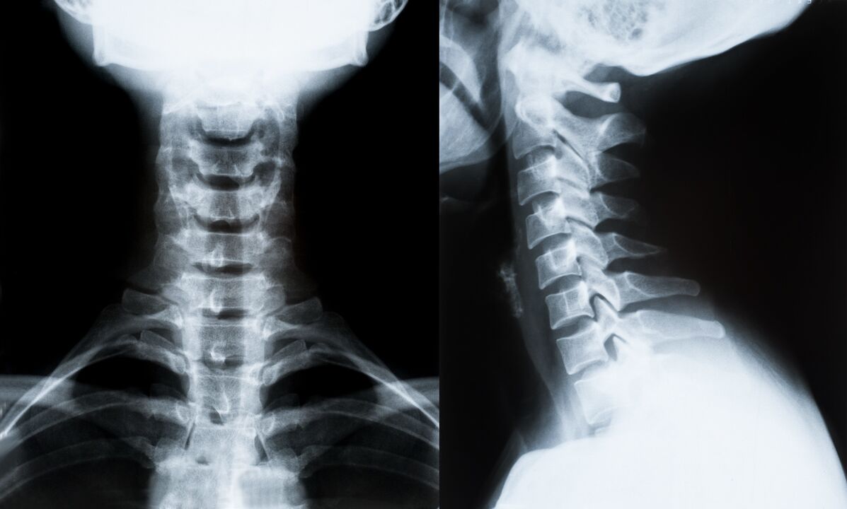 cervikální osteochondróza na rentgenu