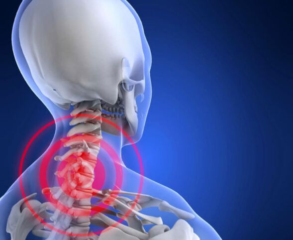 osteochondróza krční páteře