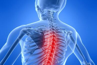 Komprese míchy u hrudní osteochondrózy